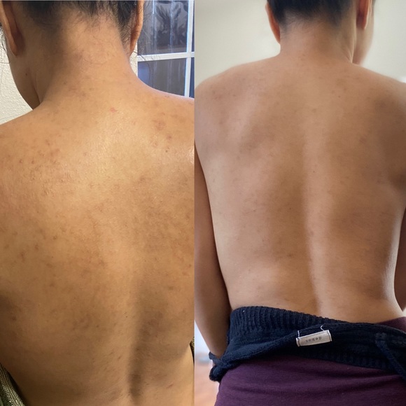 Anti Melasma Toner, Soap, Cream & Sunblock Kit Set - Picture 7 of 7